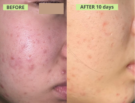 Acne-prone