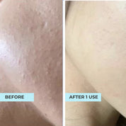 (11.11 FLASH SALES) Illuminating Oligopeptide & Acne Purifying Mask Bundle