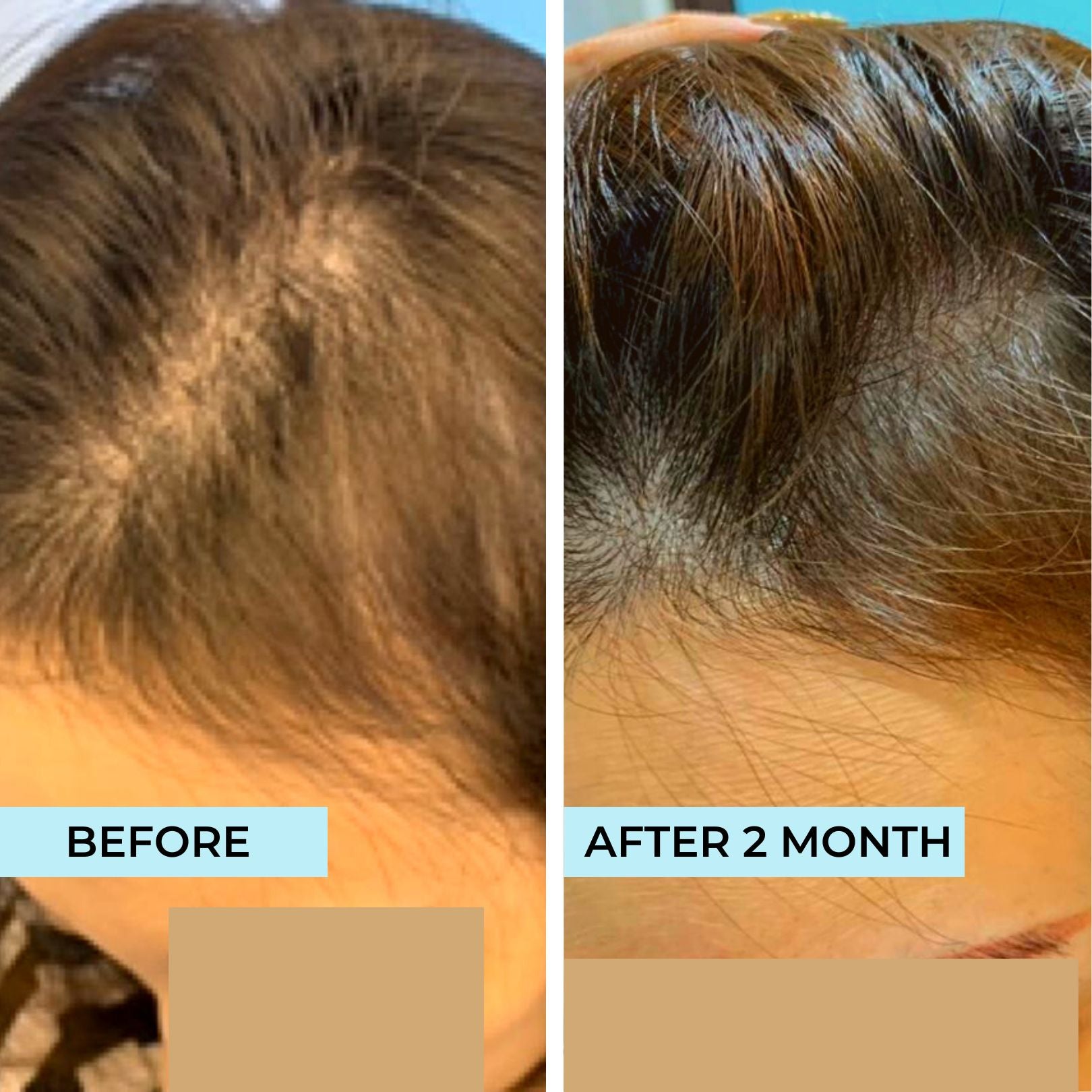 Receding Hairline Tonic