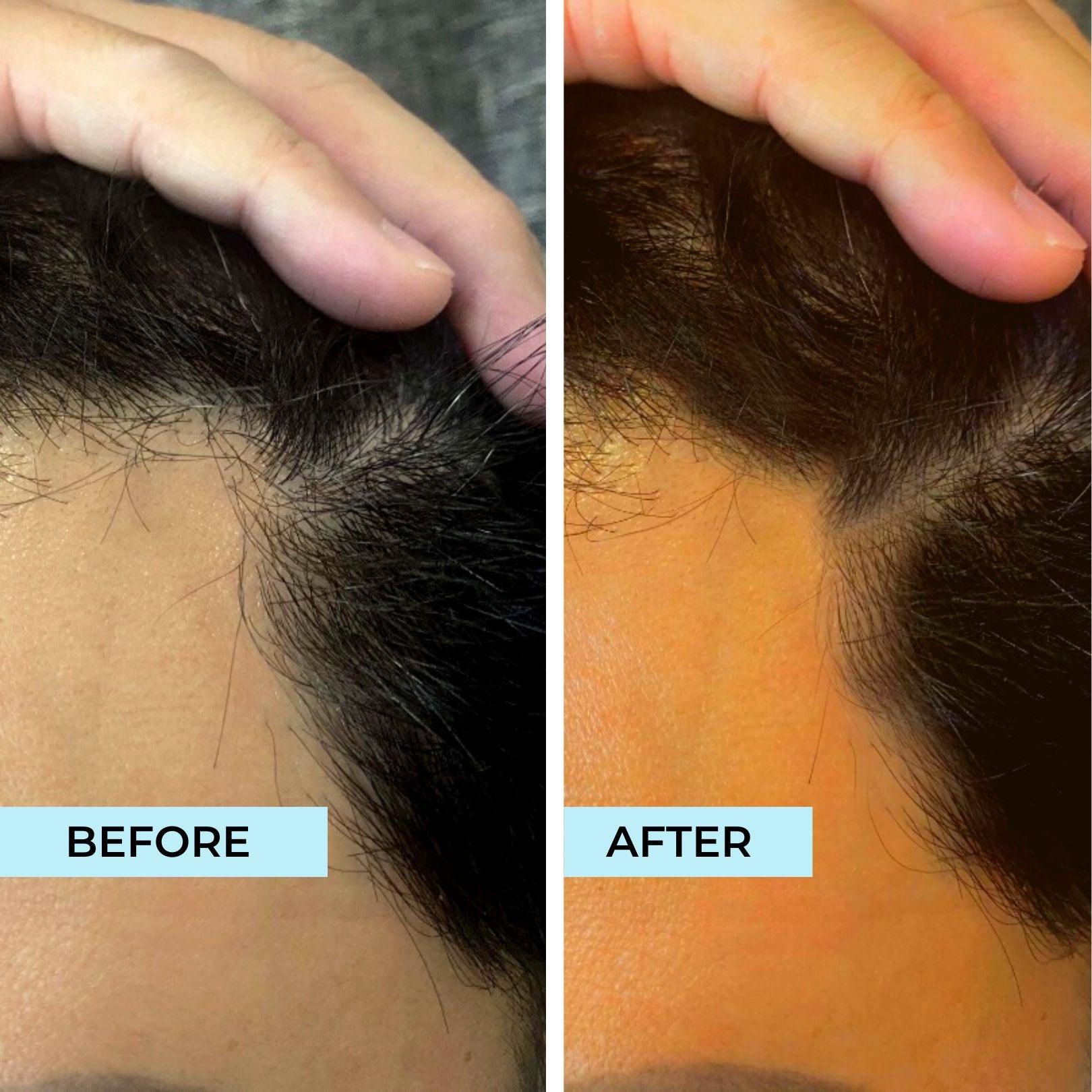 Receding Hairline Tonic
