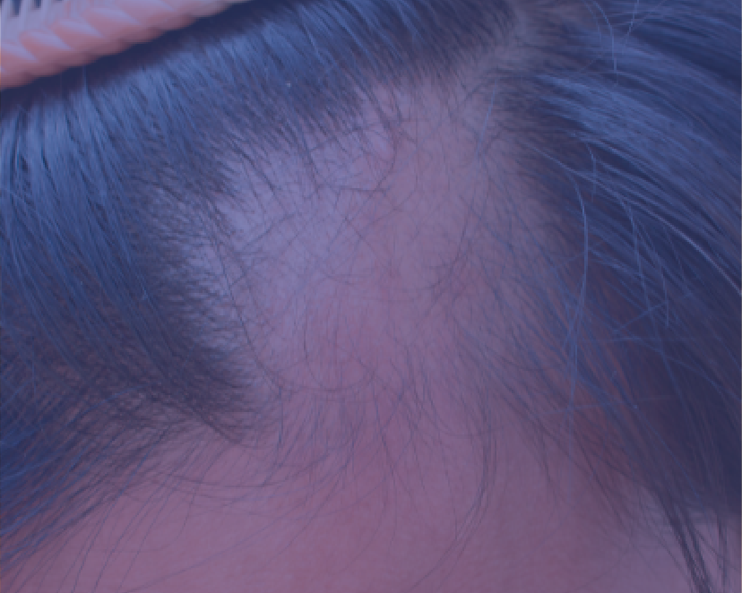 Male & Female Hair Loss