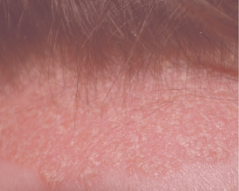Sensitive Scalp