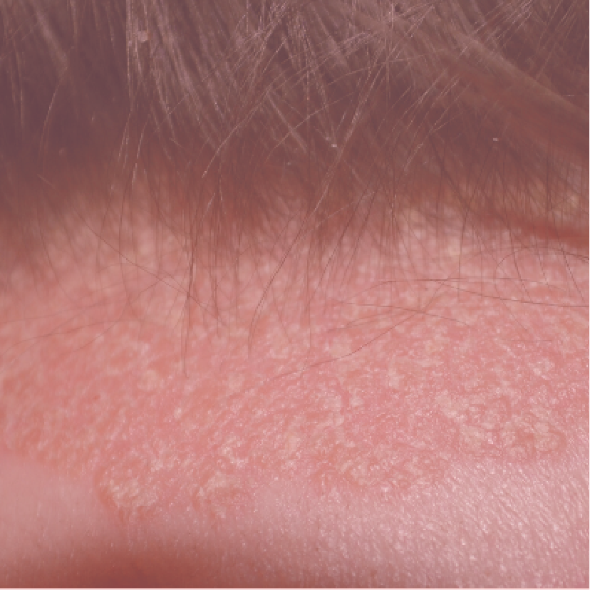 Sensitive Scalp