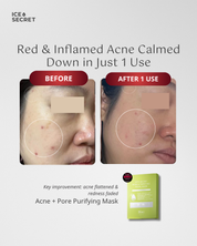 (FLASH DEALS) Anti-Acne, Pore & Oily Skin Purifying Kit