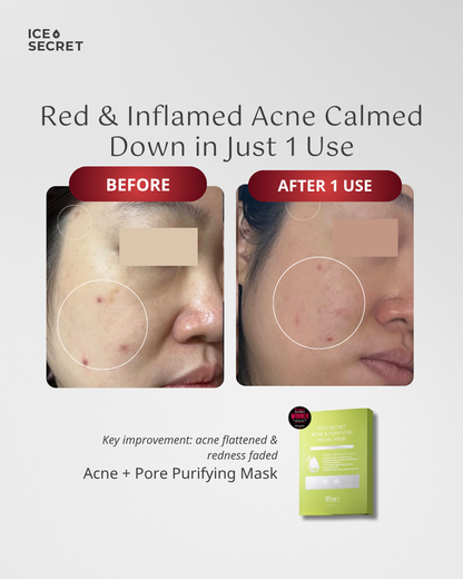 (FLASH DEALS) ACNE + PORE Purifying Away Mask Trio Bundle