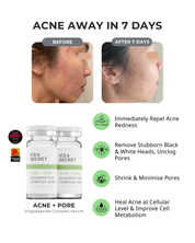 Acne Away Kit