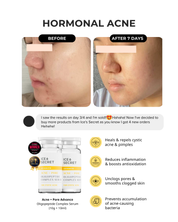 Acne Advance Kit
