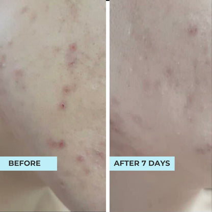 (FLASH SALES) Pore-Perfect Pair: Pore &amp; Glow + O2 Mask
