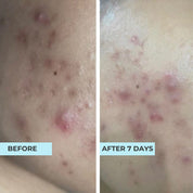 (NEW YEAR) Oil-Free Refreshing Mask FOC ACNE MASK