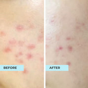 Acne Away Kit