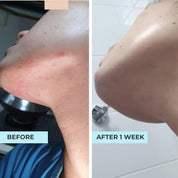 (5 in 1) Sensitive & Redness + Eczema (Eczema Skin Combo)