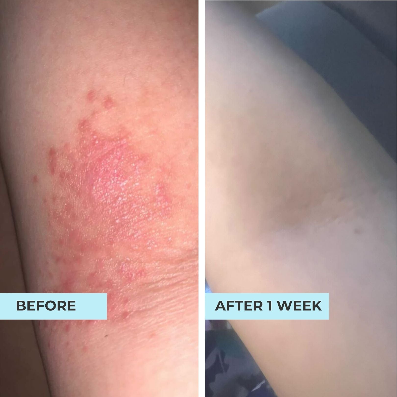 (5 in 1) Sensitive & Redness + Eczema (Eczema Skin Combo)