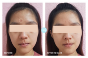 Pores · 14-Day Change (Large Pores)