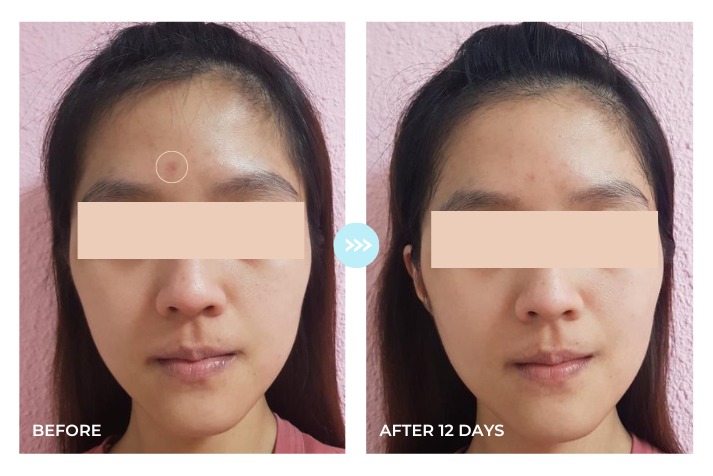 Pores · 14-Day Change (Large Pores)