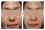 Pores · 14-Day Change (Large Pores)