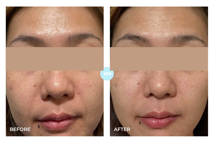 Pores · 14-Day Change (Large Pores)