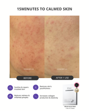 (5 in 1) Sensitive & Redness + Acne & Pore (Acne-Prone, Oily Skin & Pores)
