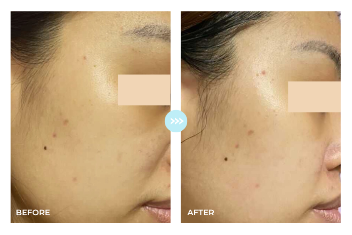 Before and after result 2