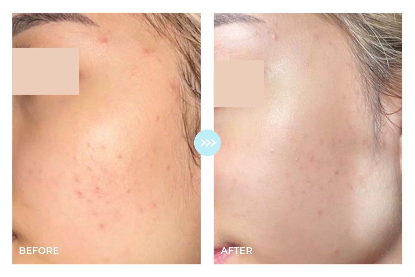 Before and after result 4