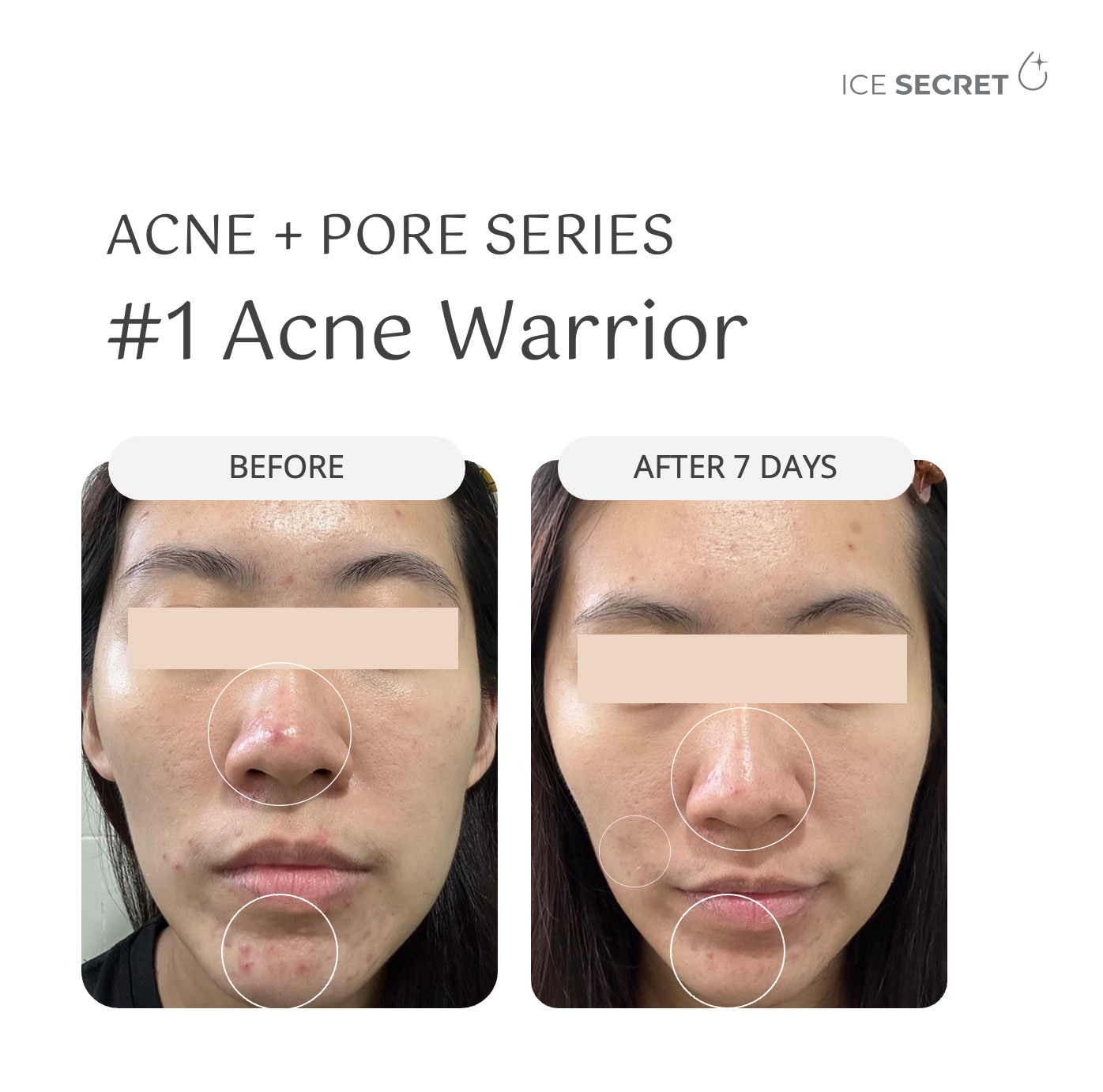 ACNE + PORE Purifying Mask