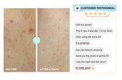 Acne Body Cleanser Bundle