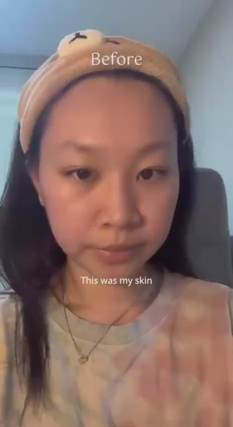 Acne & Pore 7 Days Kit