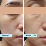 ACNE + PORE Purifying Mask