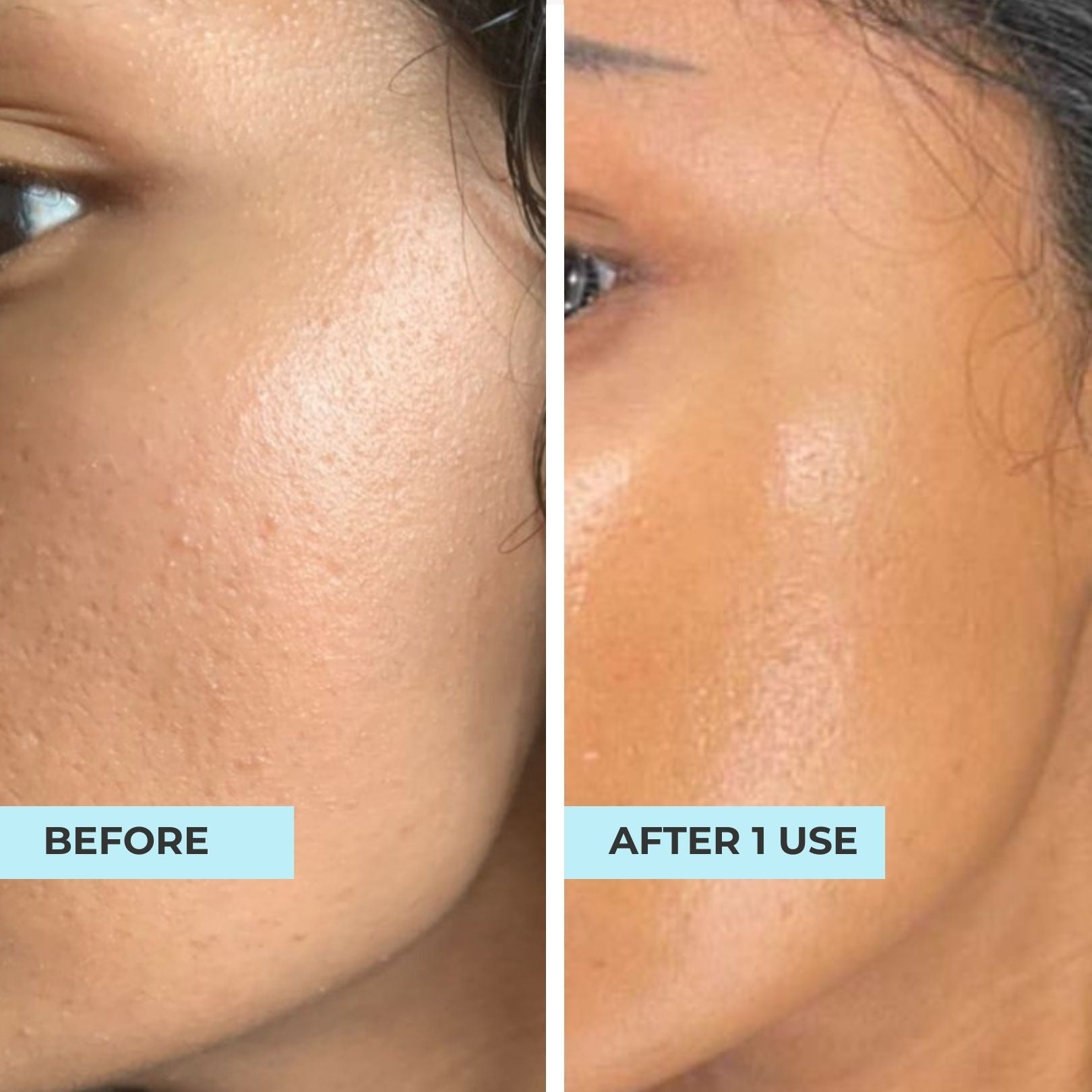 ACNE + PORE Purifying Mask