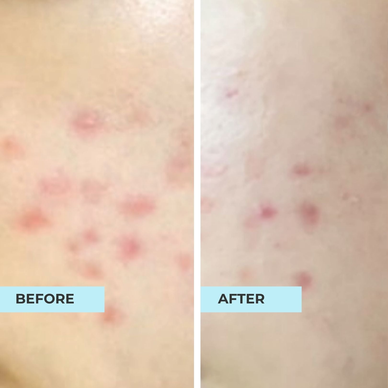 Acne Advance Kit