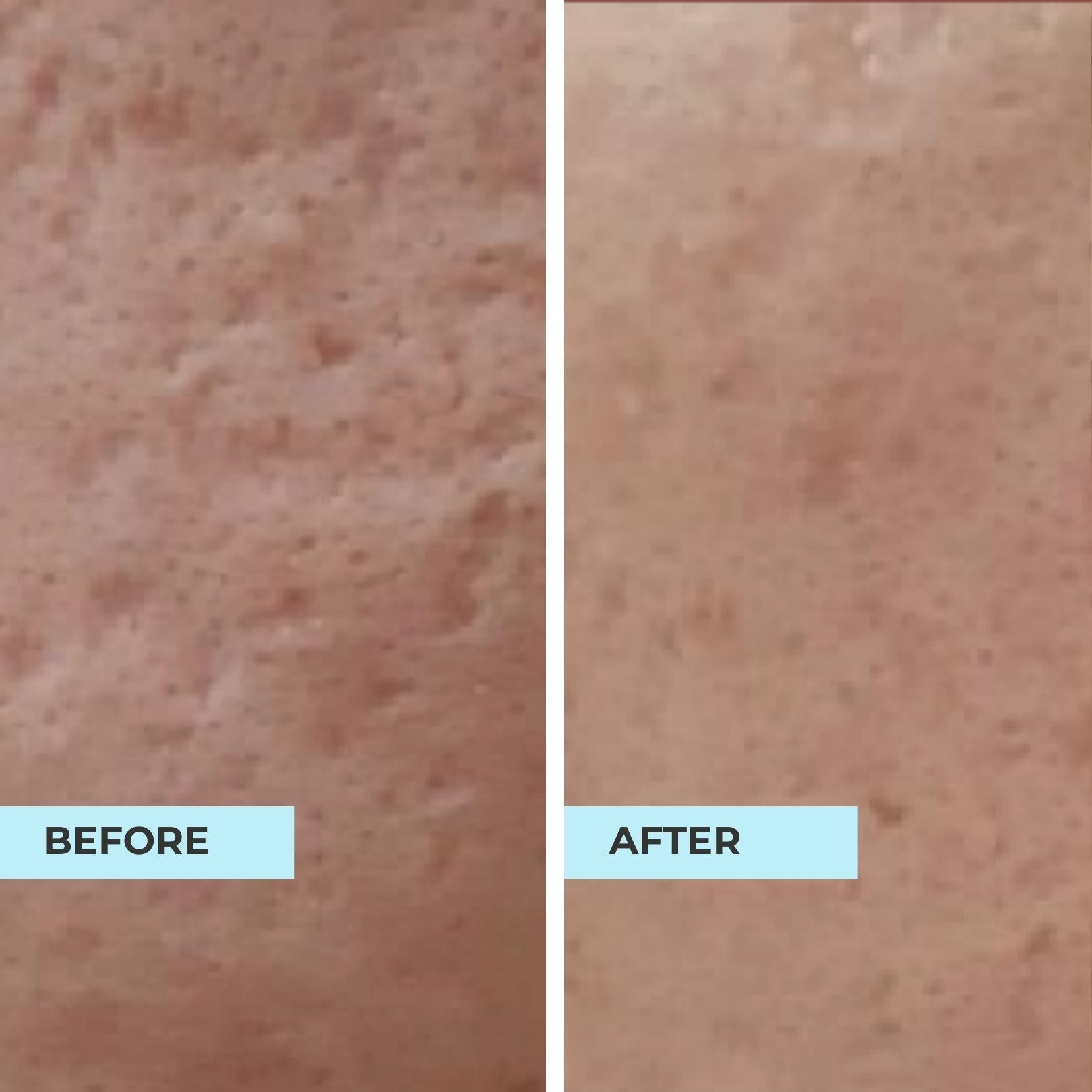 Pore Minimiser Kit (< 30 Years)