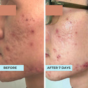 Pitted Scar Oligopeptide Complex Serum