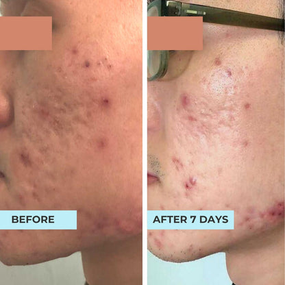 Acne Scars, Pitted Scars, Boxcar Scars, Rolling Scars Kit