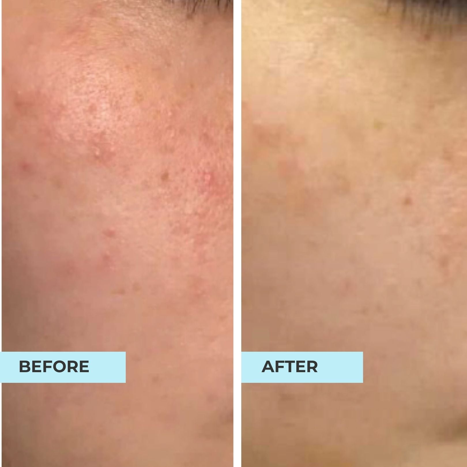 Comedones Skin & Bumps Kit