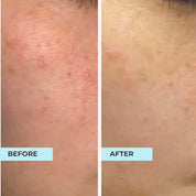 Comedones Skin & Bumps Kit