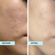 Comedones Skin & Bumps Kit