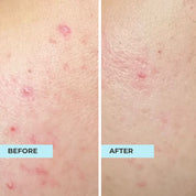 Acne Scar & Blemish Kit
